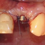немедленная установка импланта Astratech c формирователем десны