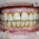 Через 2 месяца после окончательного протезирования.