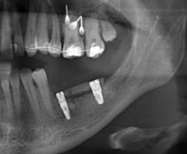 после имплантации 2