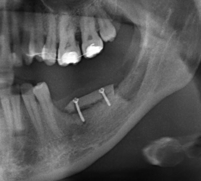 сразу после остеопластики