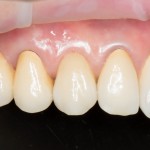 результат лечение через несколько месяцев после операции. Немедленная имплантация позволяет получить идеальный результат в кратчайшие сроки с минимальными рисками и затратами.