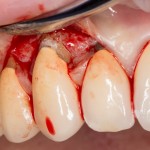 немедленная имплантация: удаление поврежденного клыка