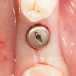 установка формирователя десны