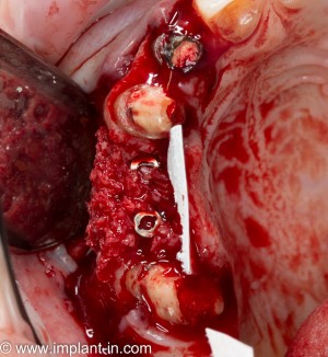 направленная тканевая регенерация требует использования биоматериалов и барьерных мембран, что отражается на ее стоимости