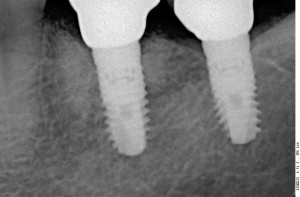 Контрольный снимок через четыре года после имплантации. Как видите, ситуация вообще не изменилась. Крайне маловероятно, что она будет меняться и далее, а следовательно об имплантах не нужно беспокоиться - они простоят всю жизнь. 