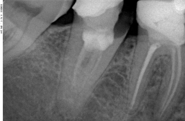 прицельный радиовизиографический снимок