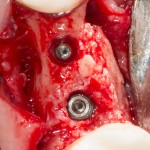 в сформировавшийся новый альвеолярный гребень установлены импланты Ankylos