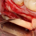 оптимальный способ забора аутокостного графта - ультразвуковая пьезохирургическая система.