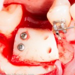 в костном блоке делается ряд отверстий, чтобы при необходимости переставлять и менять местами винты. Сейчас винты стоят в дистальной его части, поскольку мы обрабатываем медиальную часть