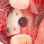 адаптированный блок и подготовленная под имплантат лунка