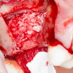 заполненное субантральное пространство. Следующий шаг - моделирование альвеолярного гребня