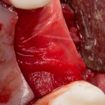 барьерная мембрана необходима для изоляции медленно регенерирующей костной ткани от быстрорастущей слизистой оболочки