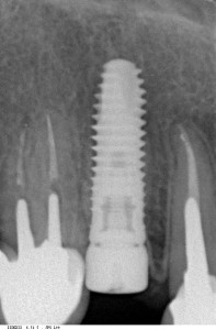 Сразу после имплантации - установлен имплантат одновременно с формирователем десны