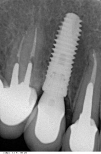 контрольный снимок через 2.5 года после имплантации. Мы видим отсутствие изменений в окружающей имплантат костной ткани - верный признак качественного лечения. Мы можем быть уверены, что такой имплантат не причинит неудобств до конца жизни.